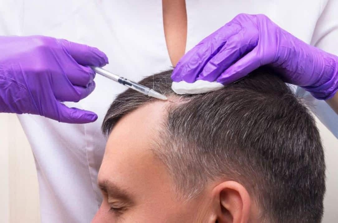 Hair Transplant Turkey: Top Benefits of Choosing Turkish Clinics