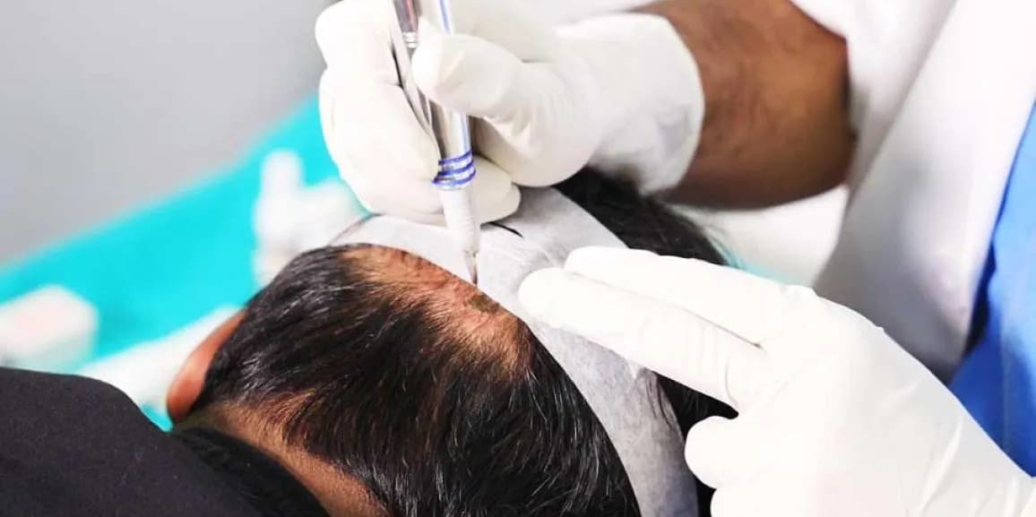 Hair Transplant Turkey: Advanced Procedures for Hair Restoration