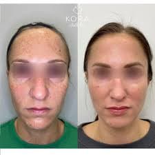 HarmonyCA Treatment for Collagen Stimulation