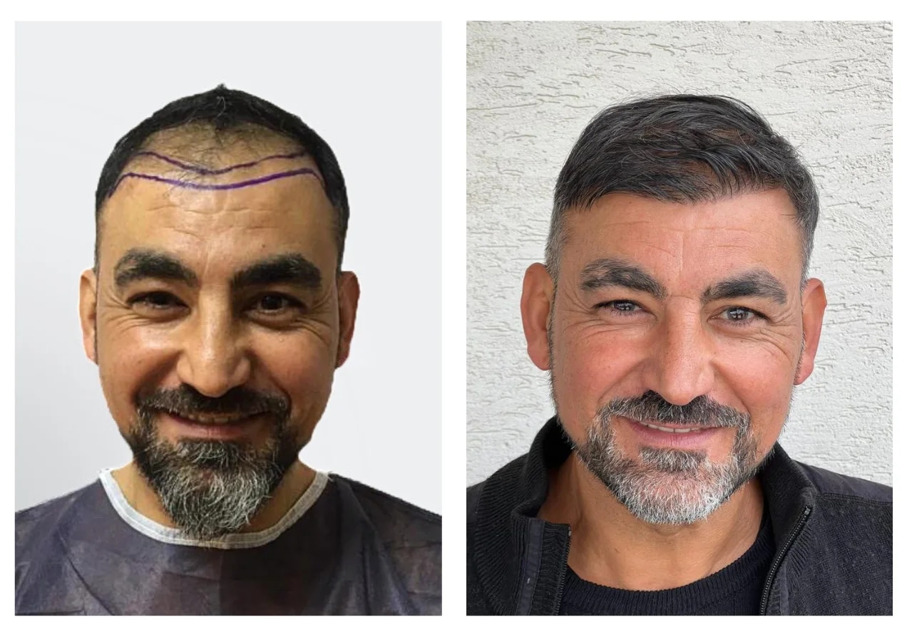 Hair Transplant London – Restoring Hair, Confidence, and Style